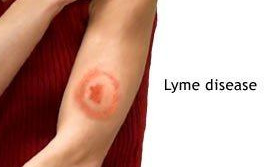 Home Invasion: II, Lyme Disease